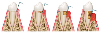 img 01 periodonti tannkjøttundersokelse